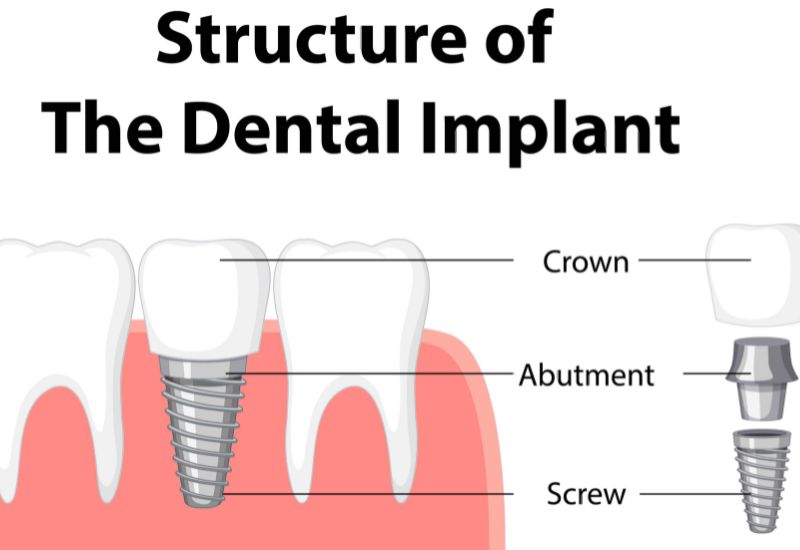 Dental implants Melbourne