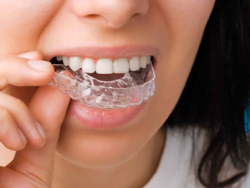 best invisalign melbourne