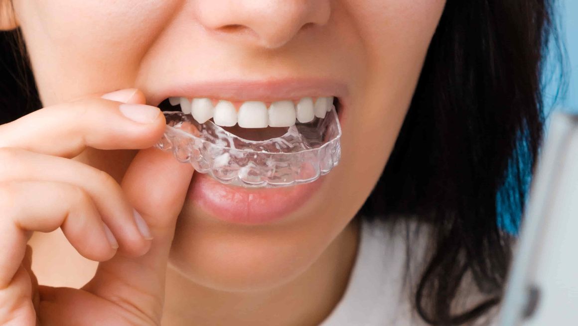 best invisalign melbourne